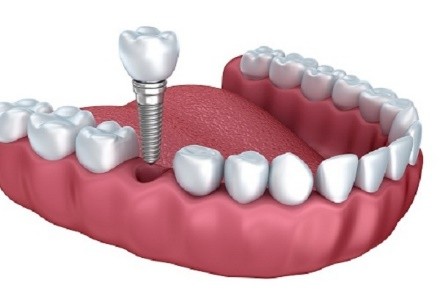 Trồng răng implant